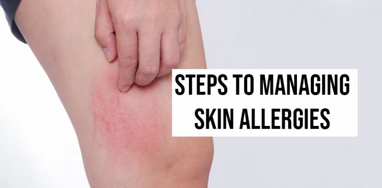 3 Steps to Managing Skin Allergies