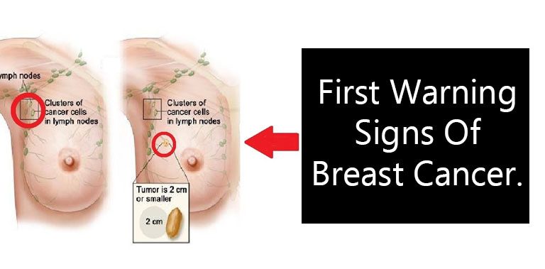 What are the first warning signs of breast cancer?