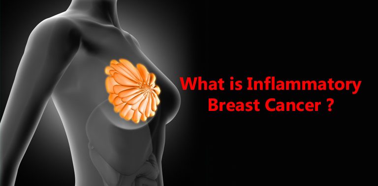 What is Inflammatory Breast Cancer