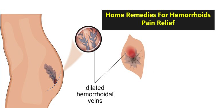 Home Remedies For Hemorrhoids Pain Relief