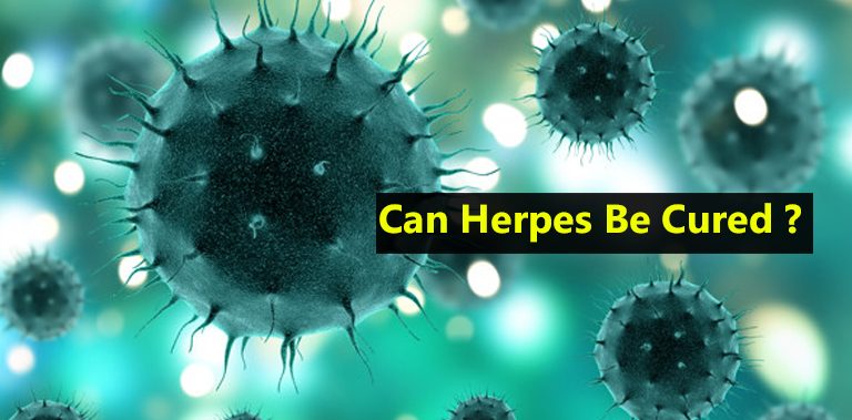 Can Herpes Be Cured?