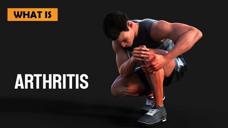 What is arthritis and how it is related to Uric Acid?