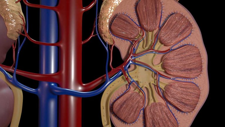 How to deal with Kidney Stones