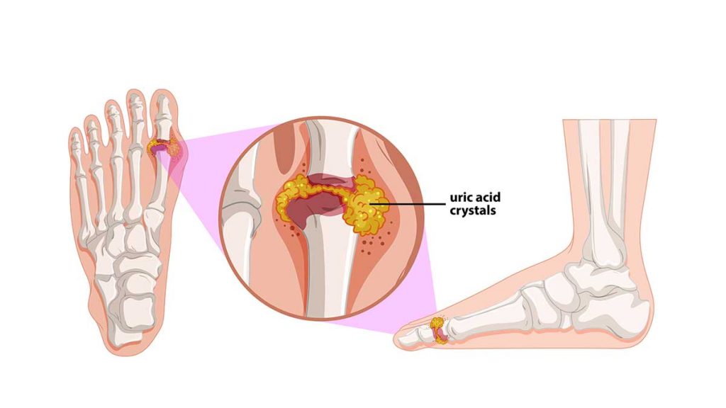 How to reduce uric acid ? Doctor ASKY