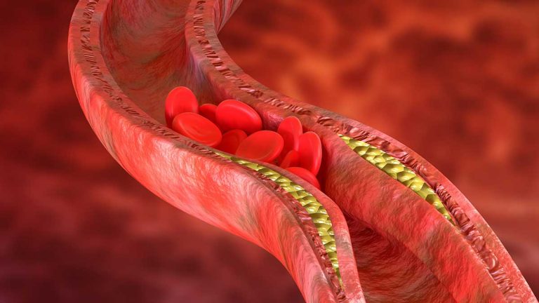 How to Prevent Arteries from Clogging ?