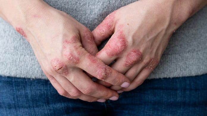 Psoriasis