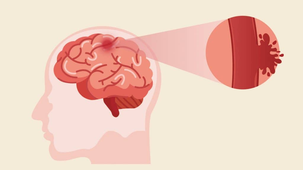 How To Recover From Brain Stroke | Doctor ASKY