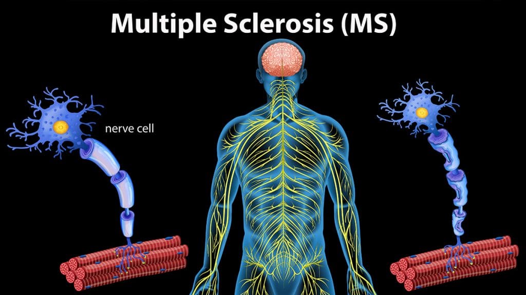 Early Signs And Symptoms Of Multiple Sclerosis. | Doctor ASKY