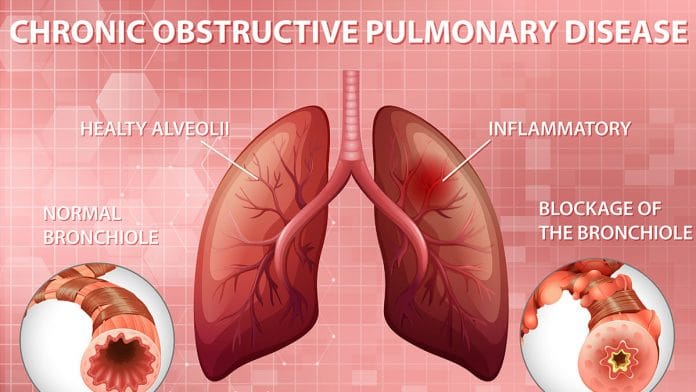 chronic obstructive pulmonary disease