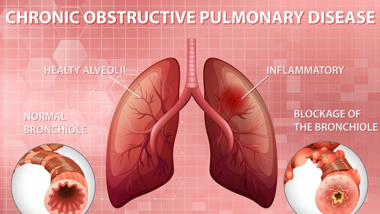 chronic obstructive pulmonary disease