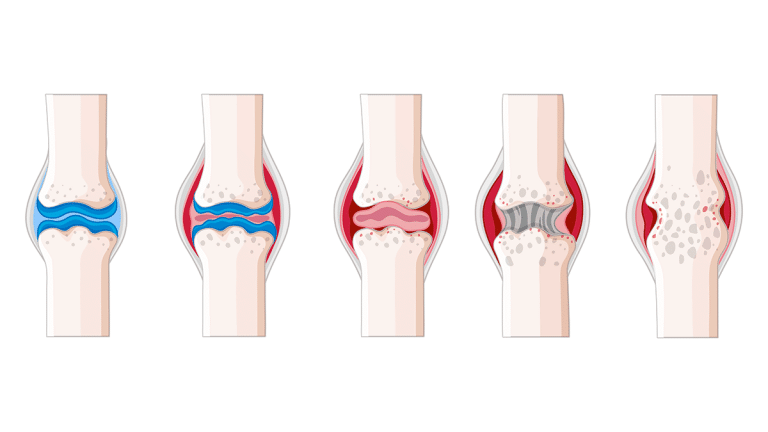 Different Types Of Arthritis