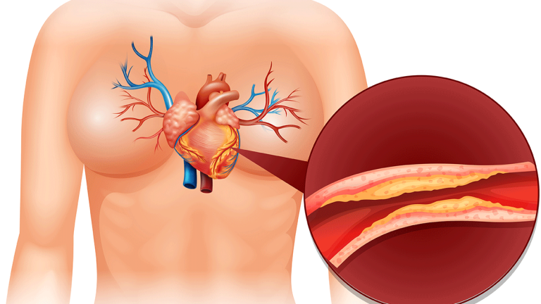 How To Deal With Cholesterol Problems