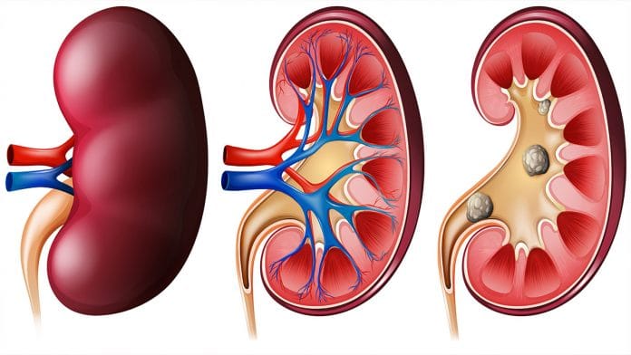 Top 10 Ways To Avoid Kidney Stones