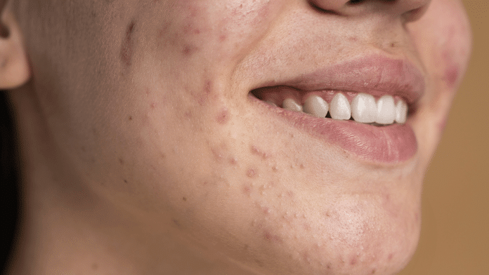 Reasons You Keep Getting Acne