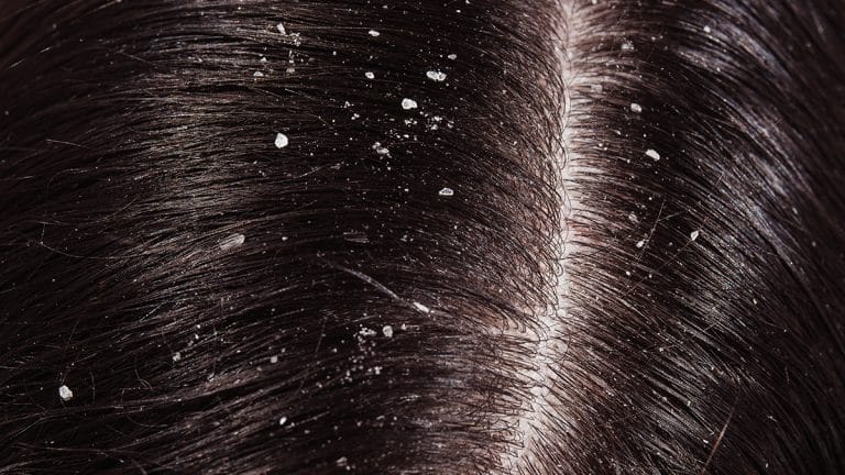 Remedies to Getting Rid of Dandruff