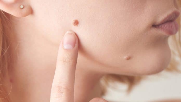 Moles On Your Body And Face